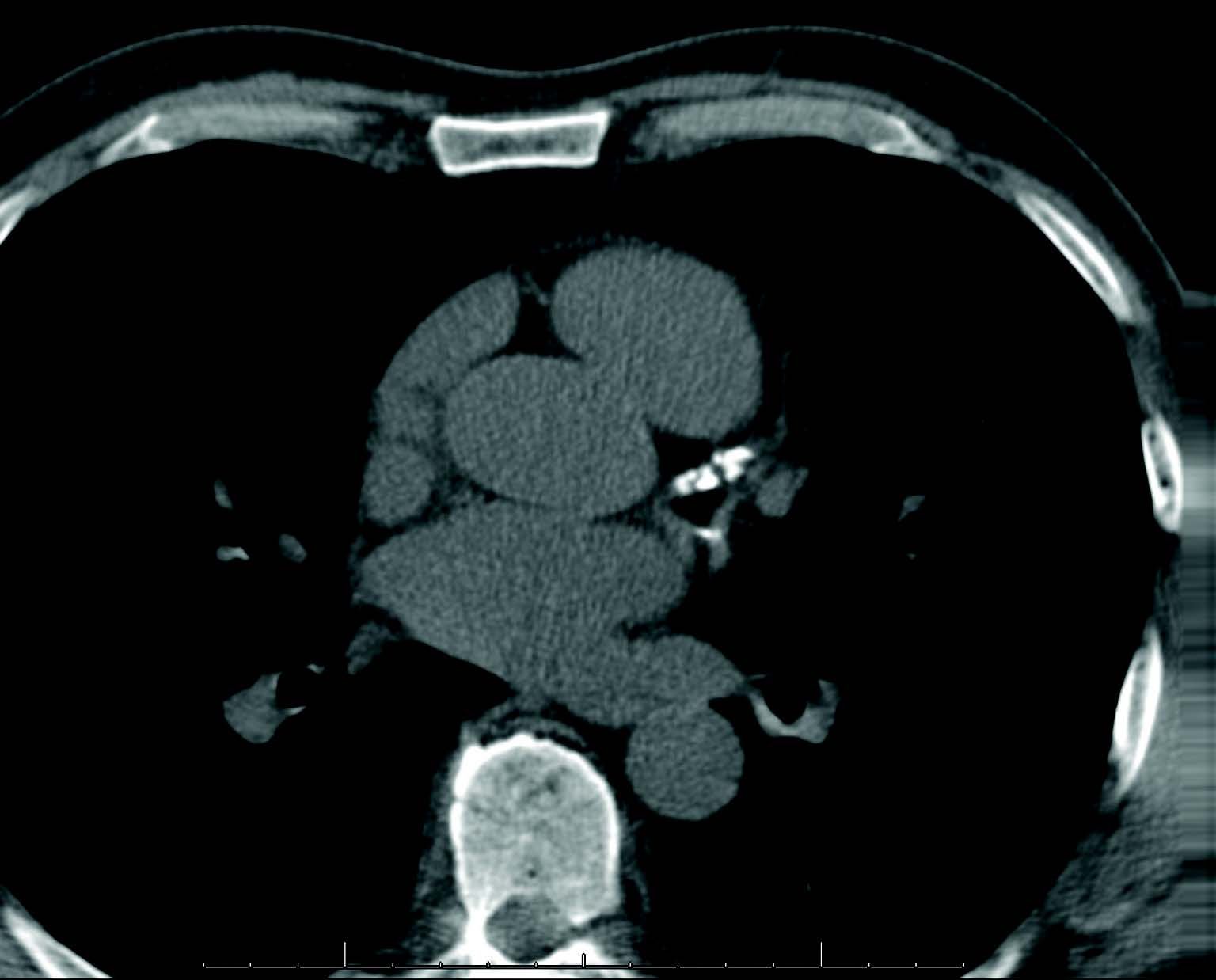 CT Heart scan image